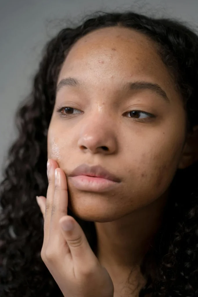 mulher com acne que vai ao dermatologista