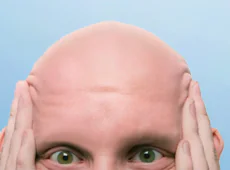 homem sem cabelo ou cílios pela alopecia areata