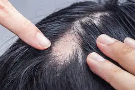 Paciente com perda de cabelo pela alopecia areata, doença autoimune.