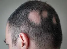 Homem com queda de cabelo autoimune chamada de alopecia areata.