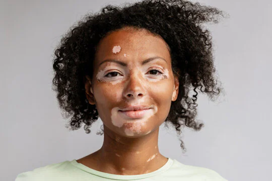 mulher com manchas brancas de vitiligo na face