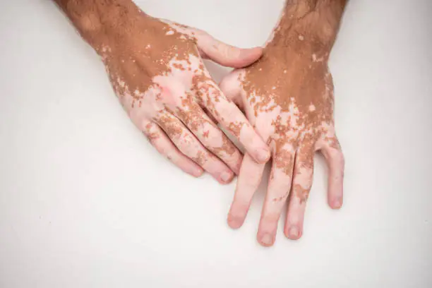 mãos de um homem com vitiligo