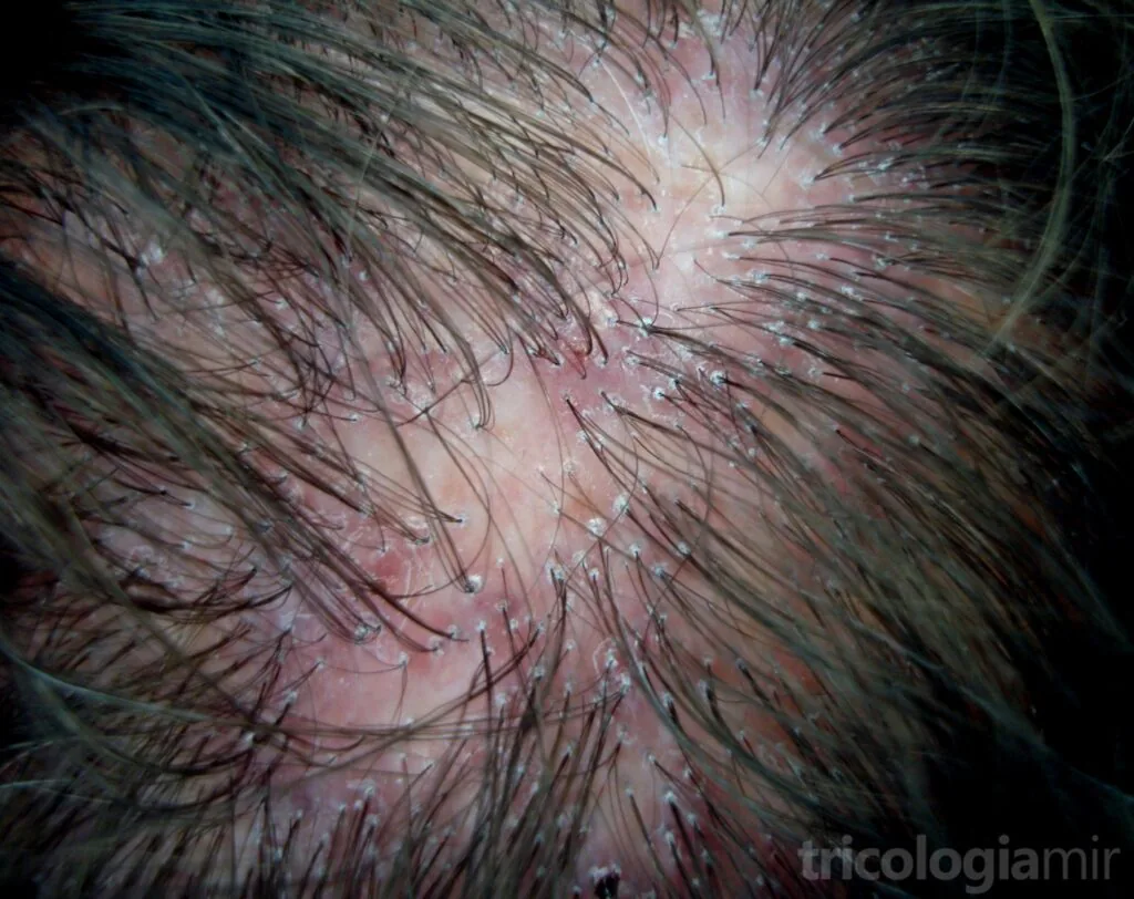 líquen plano pilar ou pilaris, uma causa de alopecia