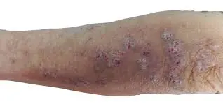 perna com prurigo nodular