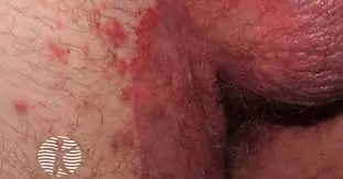 saco escrotal e virilha com psoríase genital