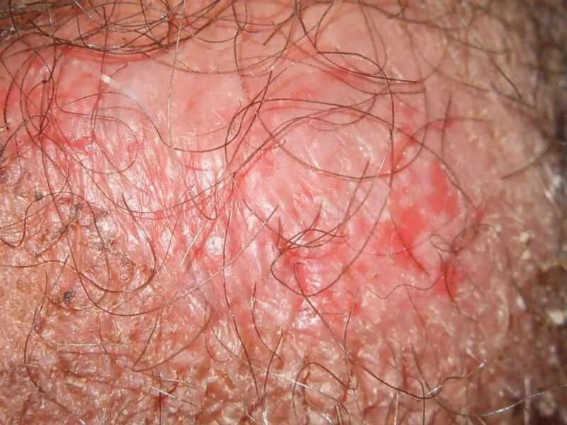 pele com psoríase genital