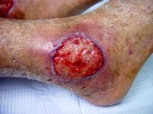 pioderma gangrenoso no tornozelo